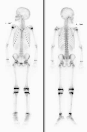 Cintilografia Óssea